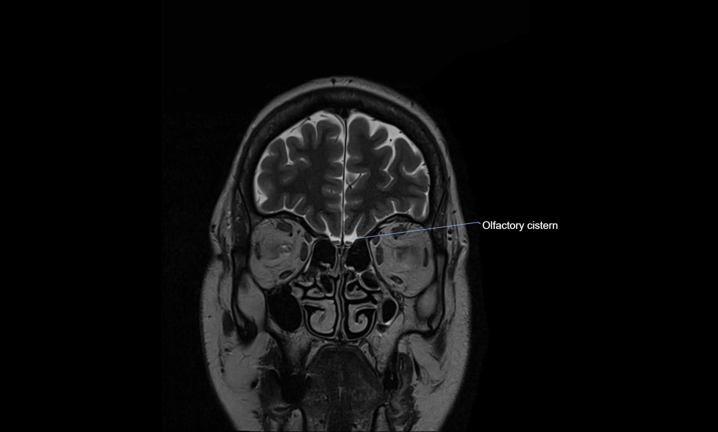 Brain cisterns  and ventricles coronal anatomy 3T MRI image-img-00001-00005.webp
